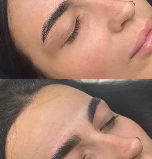 Brow treatment