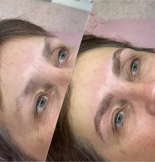 Brow treatment