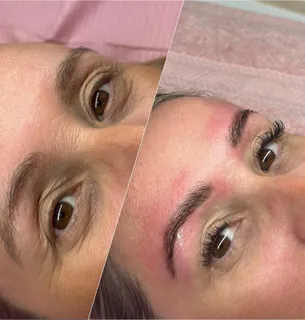 Brow treatment