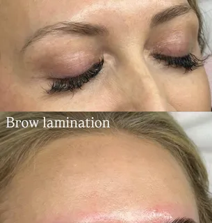 Brow treatment